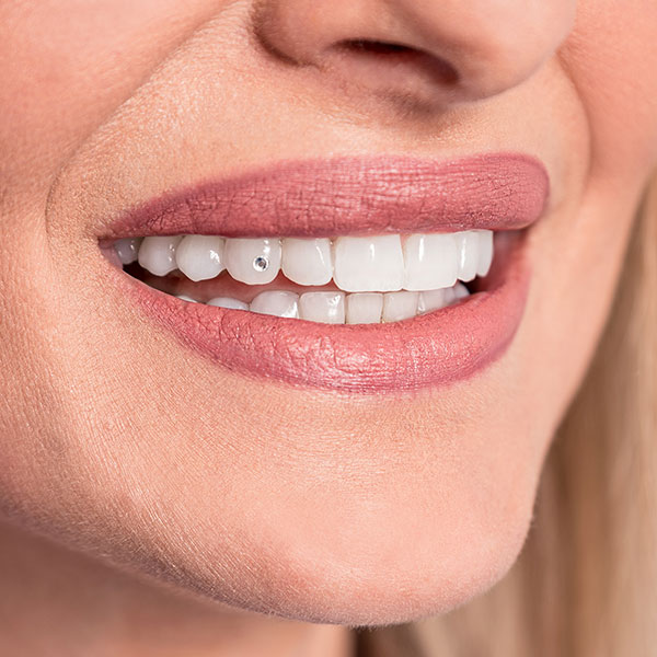 Dachau-Zahnarzt-Dr.-Gitt---Zahnschmuck Nahaufnahme eines lächelnden Mundes mit Zahnschmuck an einem oberen Schneidezahn.