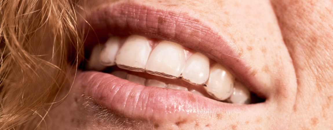 Schöner lächelnder Mund mit unsichtbare Zahnschiene von DrSmile Dachau