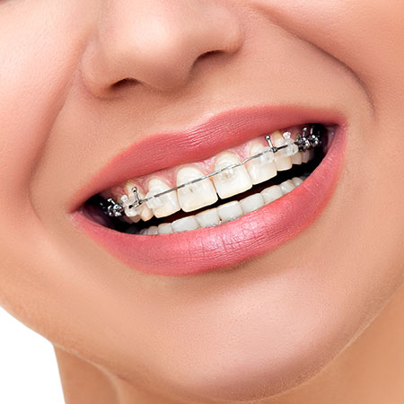 professionelle-Zahnreinigung Lächelnder Mund mit Zahnspange, die Zähne wurden trotz Zahnspange professionell gereinigt.